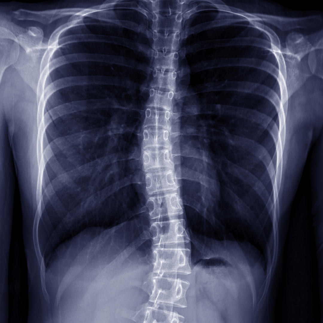 Understanding Scoliosis: Key Insights for Scoliosis Awareness Month